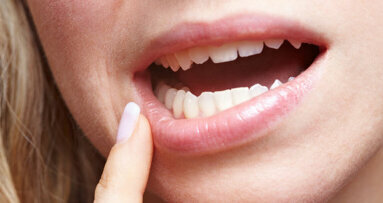 Le calcium contenu dans les gels de blanchiment des dents, réduirait la sensibilité dentaire
