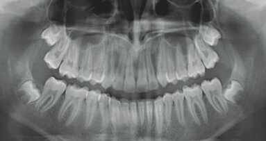 Treatment of Class II division 1 malocclusion treatment with mandibular advancement features