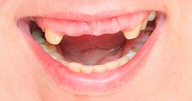 La perdita dei denti potrebbe rallentare le funzioni del corpo e della mente