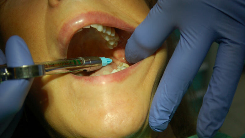 L’estrazione dentale: un atto da non sottovalutare