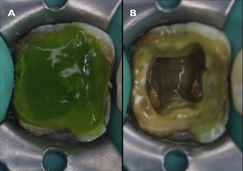 Figs. 7a & b: Etching of the dentine and enamel with phosphoric acid (a). Application of a universal adhesive after rinsing and drying (b).