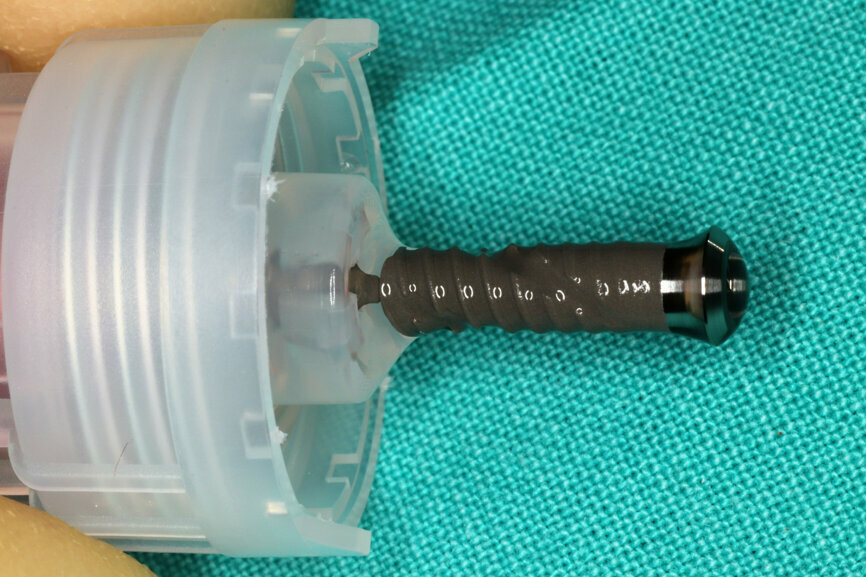 Fig. 11:  Straumann TLX implant ready for pick-up on the vial cap.