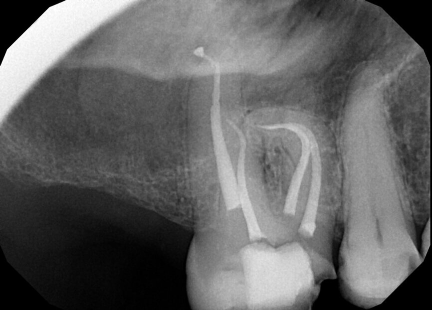 Fig. 18b: Note the expert management of the apical constriction and the acute curvature of the MB root. (Courtesy of Dr. Nestor Cohenca)