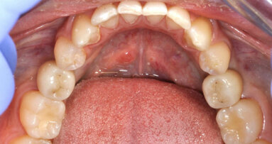 L’approccio “Tooth-Like” in implantologia