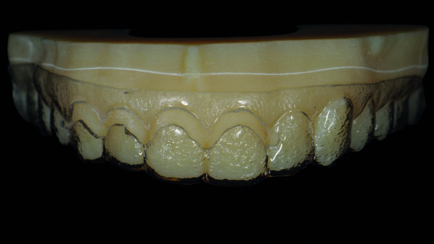 Fig. 5 : Modèle imprimé en 3D issu de la conception numérique du sourire, pourvu d‘un make-up. Une ouverture au niveau cervical a été prévue pour faciliter l‘accès et le guidage au cours de la chirurgie d‘élongation coronaire. 