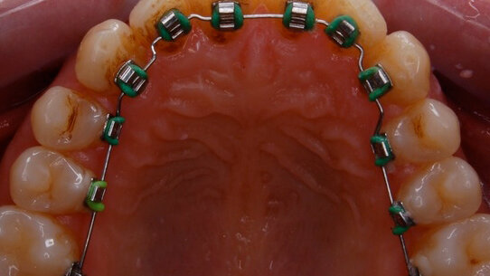 Cosmesi ortodontica con una apparecchiatura linguale 2D. Indicazioni, vantaggi e limiti