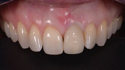 Remplacement d’une dent unitaire en zone esthétique : l’apport de la préservation alvéolaire pour un résultat final durable