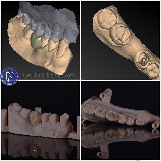 Slika 9: izgled definitivnog dizajna mosta u  exoced-ovom dental CAD programu, kao i završenog merilend mosta; stomatološka ordinacija Varga, dr Zoran Varga