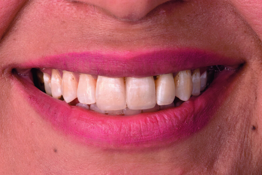 Fig 4. Patient smile after direct mock-up