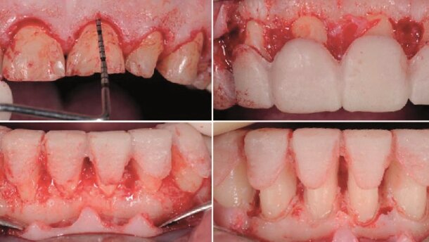 Sposoby odbudowy zębów z silną abrazją