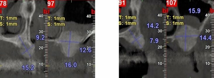 Fig. 5 - Sezioni CBCT post-operatorie (sinistra) e al controllo a 6 mesi (destra). Dopo l’intervento (sinistra) lo spessore osseo in corrispondenza alla posizione 2,4 era passato da 8,5 a 9,2 mm e la distanza cresta/pavimento naso da 4,4 a 15,2 mm, mentre in posizione 2.6 lo spessore osseo era passato da meno di 1 mm a 12,6 mm, con 16 mm di profondità intra-sinus. Dopo sei mesi, si osservava in posizione 2.4 una riduzione dello spessore trasversale da 9,2 a 7,2 mm e da 15,2 a 14,2 in altezza, mentre i volumi ossei rigenerati nel seno mascellare erano invariati.