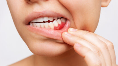 Parodontalno zdravljenje je neučinkovito pri težkih kadilcih s hudim parodontitisom, ugotavlja študija