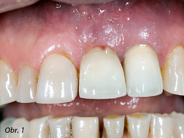Exsudát u zubních implantátů ve frontální oblasti