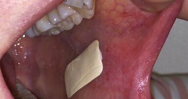 Interview: The Rivelin patch sticks to the mucosal surface for much longer than any other treatment