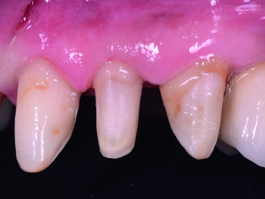 Fig. 6 : Vue détaillée du côté gauche des préparations dentaires.