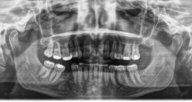 Intrusione molare con allineatori trasparenti per ottimizzare un trattamento implanto-protesico