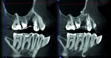 La technologie 3D dans le diagnostic et le traitement des maladies endodontiques