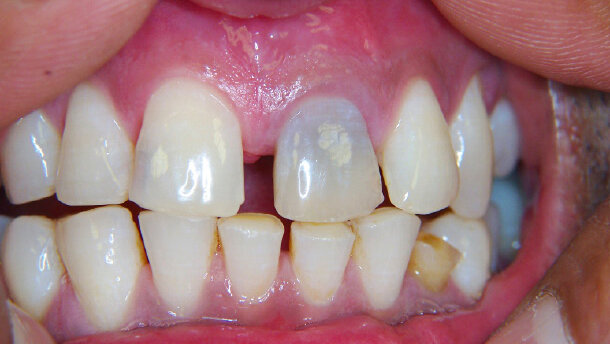 Vnitřní bělení horního  levého velkého řezáku: Jacob Krikor se podělil o své zkušenosti  s bělením zubů – řezáků