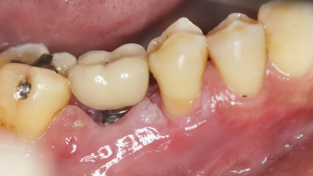 EFP releases peer-reviewed guideline on peri-implant disease prevention and treatment