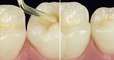 Ceram.x universal: excellente adaptatie en modelleerbaarheid