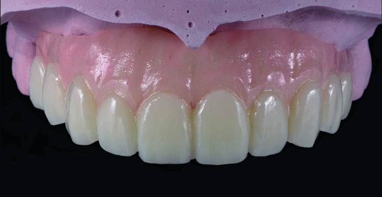 Fig 14. Ceramage GUM Opaque (GUM-O) was applied to mask the color of PMMA.
