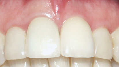 Immediate single-tooth replacement, provisionalization