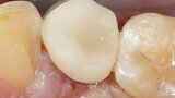 Fig. 11. La restauración de cerámica de feldespato durante la prueba clínica en boca.