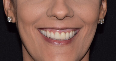 Estética dinámica en la sonrisa gingival con Botox