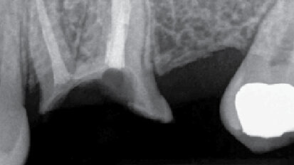 Význam endodoncie při plánování implantologické léčby
