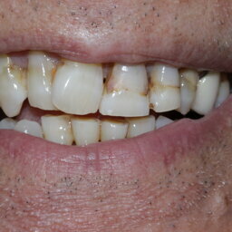 TMD to Smile Design (case done by programmed treatment planning in a conservative way)