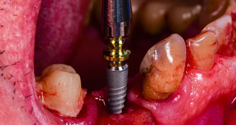 Three steps to enhance your dental implant laboratory