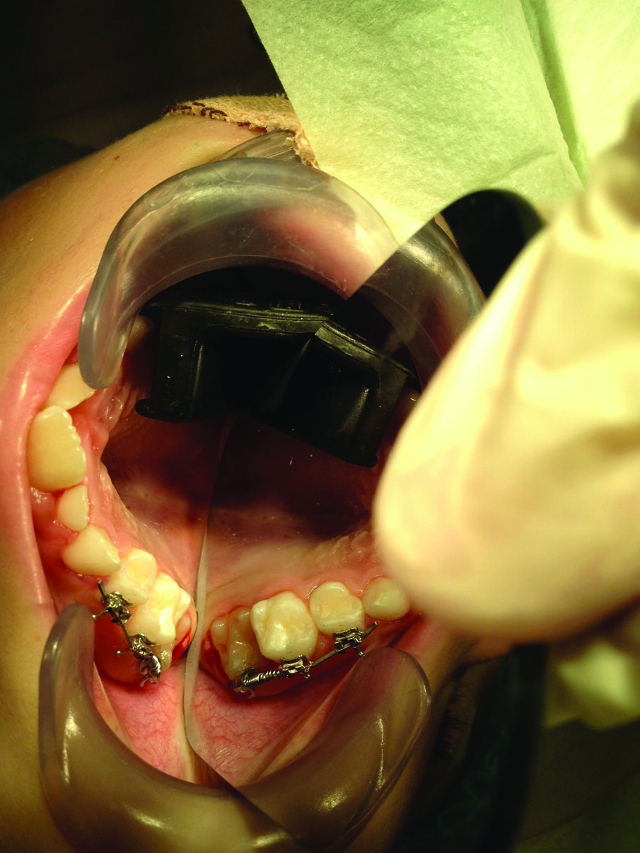 Figure 4: An ectopically erupted first primary molar corrected by an open coil spring fixed orthodontic appliance.