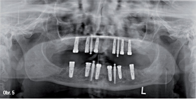 OPG snímek se 16 zavedenými implantáty a augmentovanými oblastmi