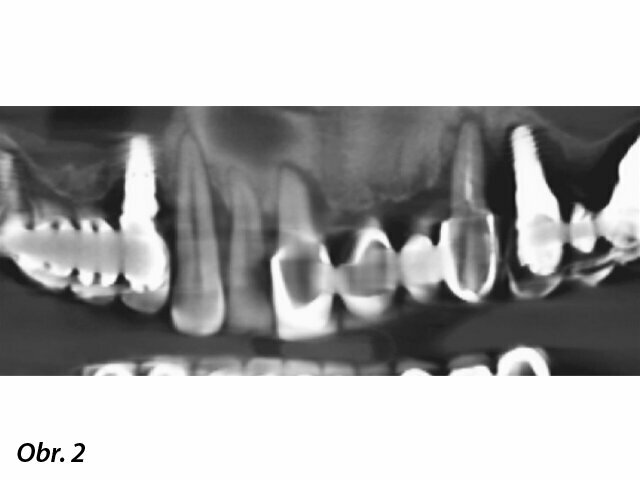 CBCT sken zachycující dno sinu a sníženou výšku kosti na obou stranách horní čelisti.