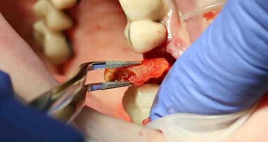 Atraumatic extraction of maxillary second premolar