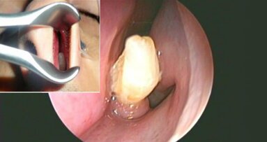 過剰歯が男性の鼻腔内で成長