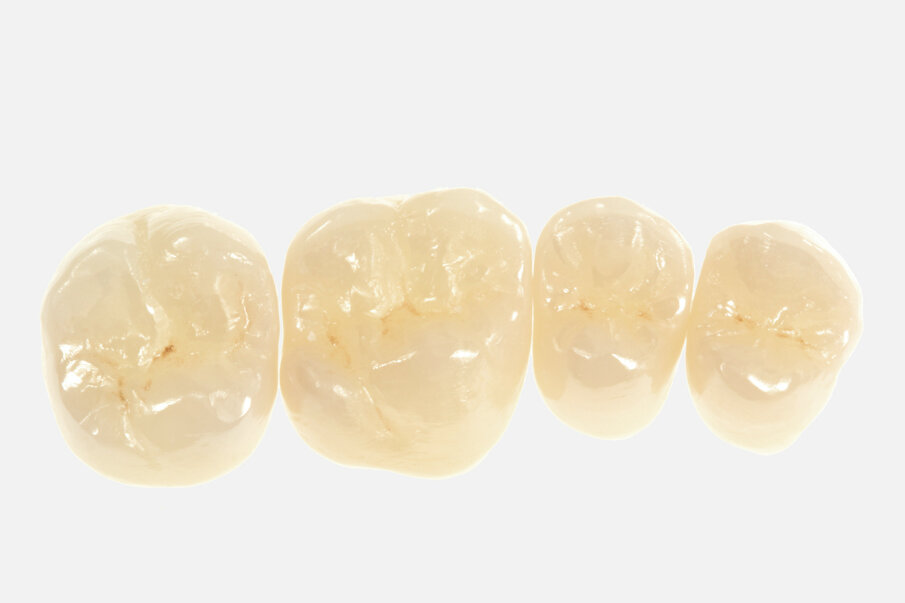 Fig. 19: The combination of areas with monolithic zirconia and areas with buccal veneering combines the entirely different advantages of two ceramics.