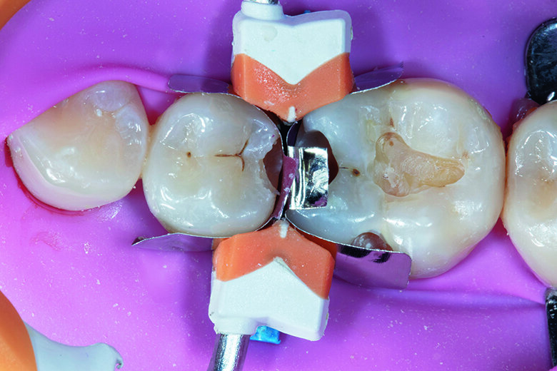 Fig. 3. Garrison FX150 band for the premolar and FX175 for the molar was placed with the Garrison 3D Fusion Blue Wedge and the Garrison 3D Fusion Orange Ring (FX500).