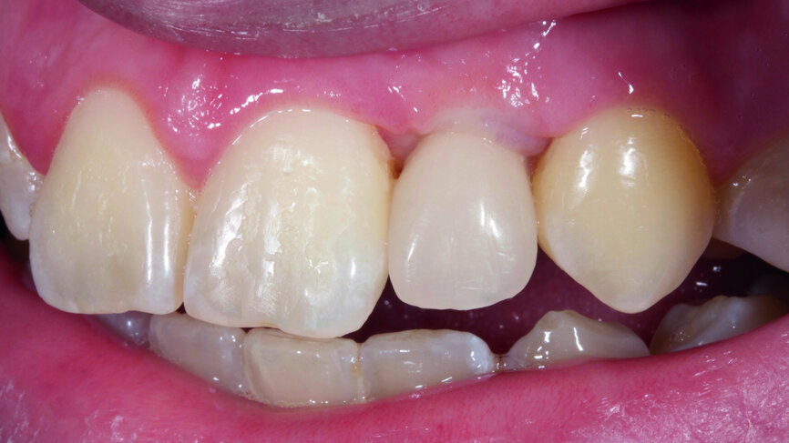 Fig. 11: Crown lengthening was performed on tooth #12.