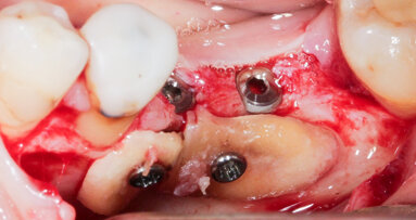Augmentace pomocí radixu zubu. Použití kořenů zubů v rámci ošetření při nedostatečné nabídce kosti