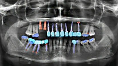 Artificial intelligence-based analysis of dental radiographs saves time in patient care