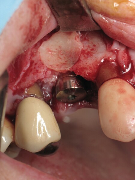 Fig. 8 : Implant RN non enfoui, carotte osseuse totalement immobilisée. 