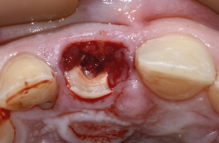Fig. 9: Visible granulation tissue at the resorption and fracture area of tooth #11.