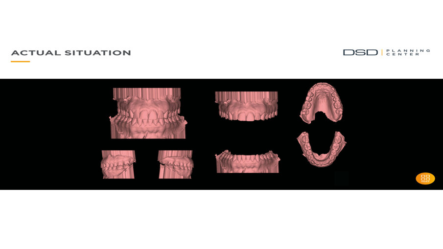 Fig. 3_Scannerizzazione della bocca della paziente.