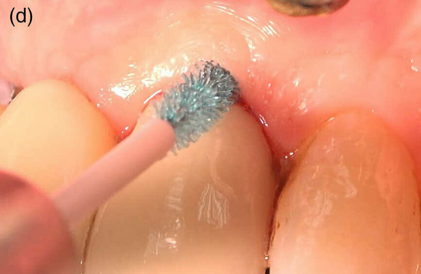 Fig 1 (d) : Nettoyage mécanique de la surface des implants avec une brosse en fibres de chitosane rapidement biodégradables, fixée à une pièce à main rotative.