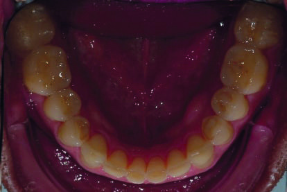 Fig. 3 : Photographie intraorale avant le traitement, vue occlusale de la mandibule. 