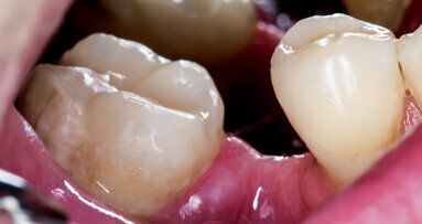 Growing new teeth: Researchers pursue “every dentist’s dream”