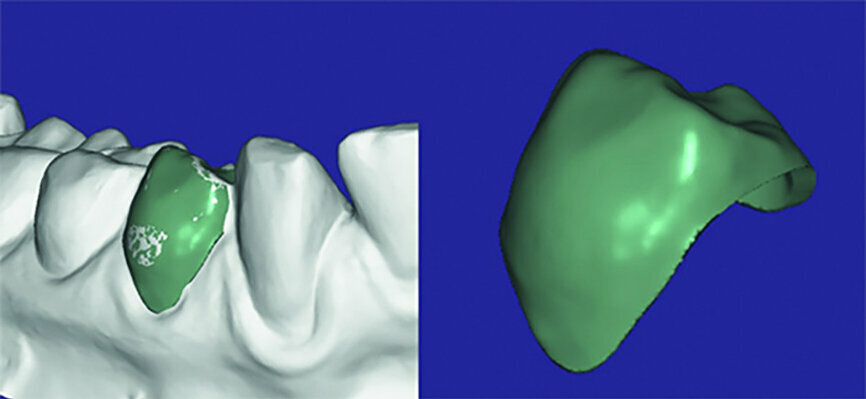 Fig. 4: Creating eggshell temporaries for tooth #45 with the exocad provisional module.