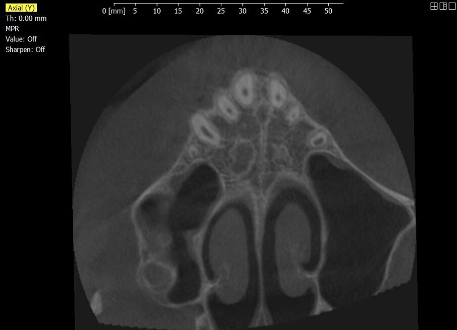 Fig. 3_La CBCT permette di analizzare la morfologia della sutura palatale, in questo caso identificata con uno stadio C.