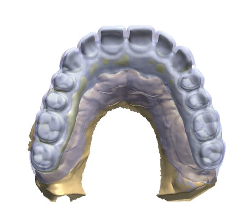 Fig. 9: A planted scan of a temporary prosthesis (blue colour) on the construction design.